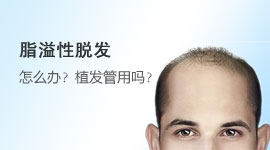 脂溢性脱发